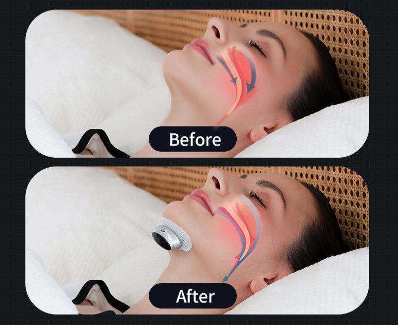 Comfortable, reusable AirEase anti-snore nasal clip, a travel-friendly breathing aid for better sleep.