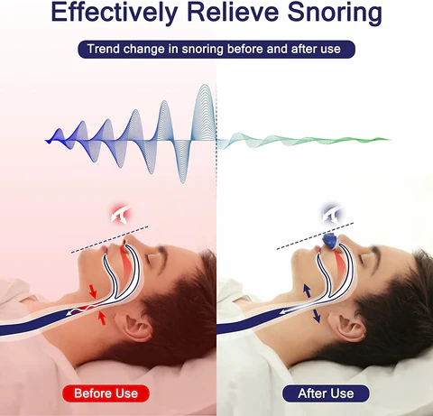 Travel CPAP: Sandsberg nasal device offers maskless sleep apnea & snoring relief for improved sleep.