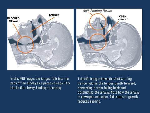 Medical-grade tongue stabilizer & snore stopper. Oral device for anti-snore and sleep apnea relief.