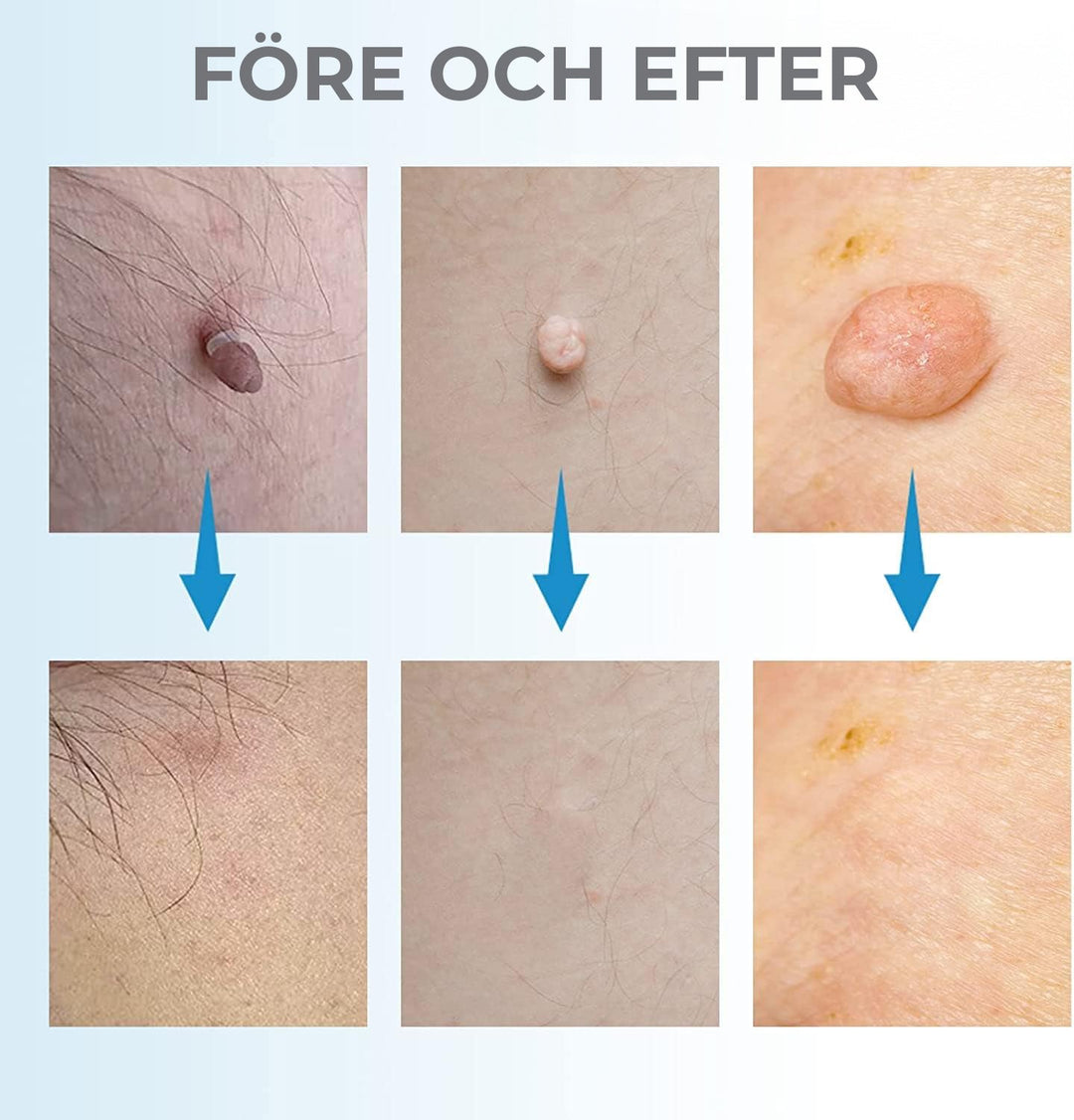 Cosmetic kit for at-home skin tag removal & blemish treatment. Achieve smooth, clear skin with this beauty tool.