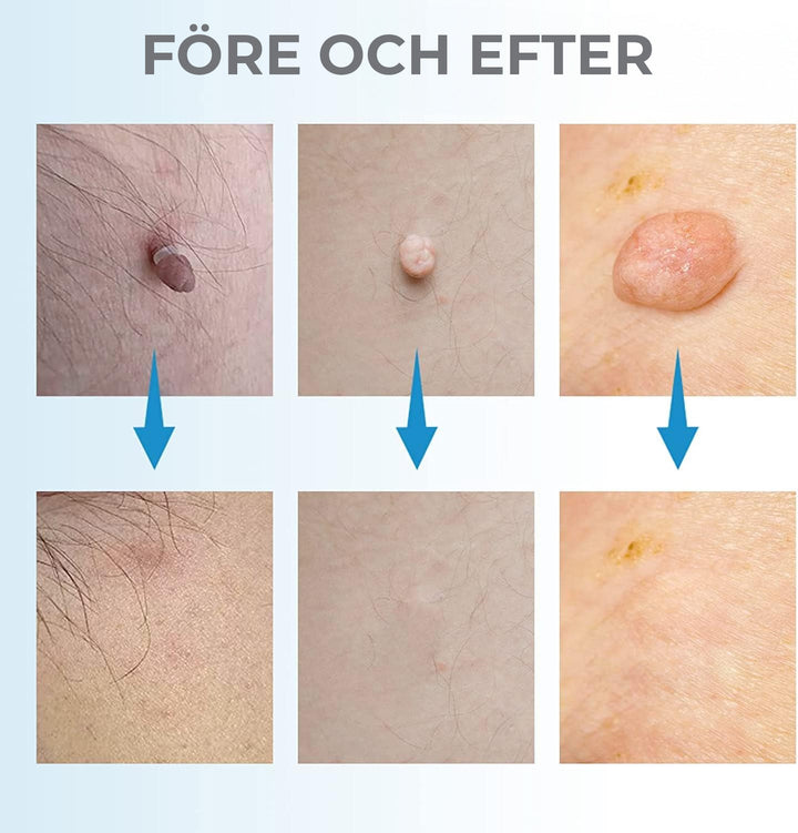 Cosmetic kit for at-home skin tag removal & blemish treatment. Achieve smooth, clear skin with this beauty tool.
