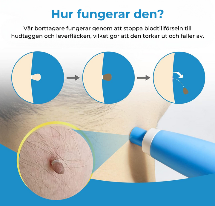 At-home skin tag remover kit. Effective wart & blemish removal for all skin types. Get smooth, clear skin.