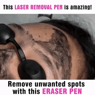 Compact home laser pen for effective spot & tattoo removal. A portable skin care device & beauty tool.